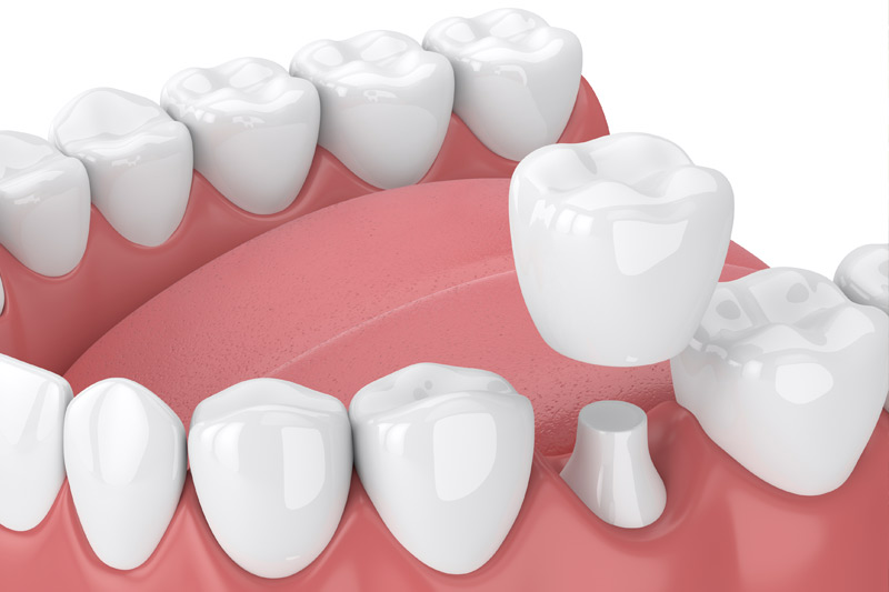 Dental Crowns in Salina