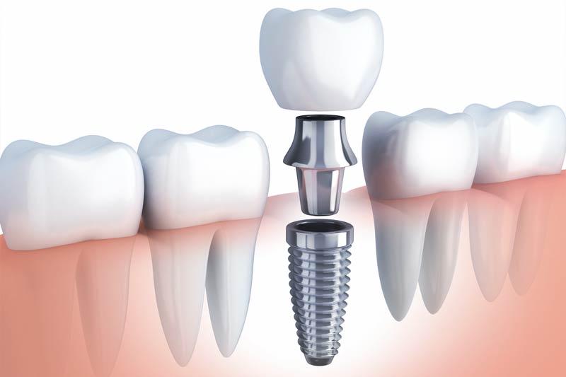 Implants Dentist in Salina