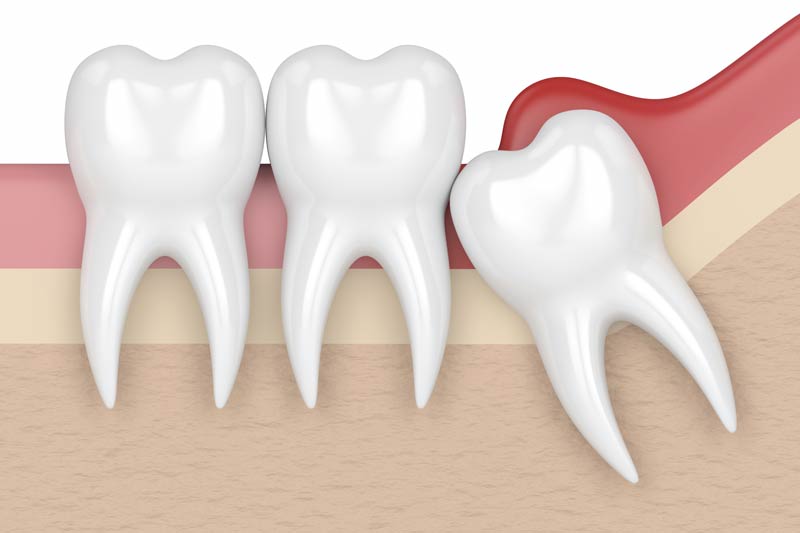 Wisdom Tooth Removal in Salina